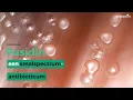 Fusidin een smalspectrum antibioticum