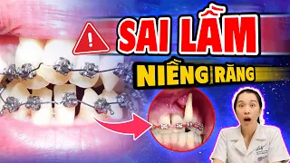 Măc Cài Tốt Chưa Đủ! 4 Yếu Tố Quyết Định Kết Quả Niềng Răng.