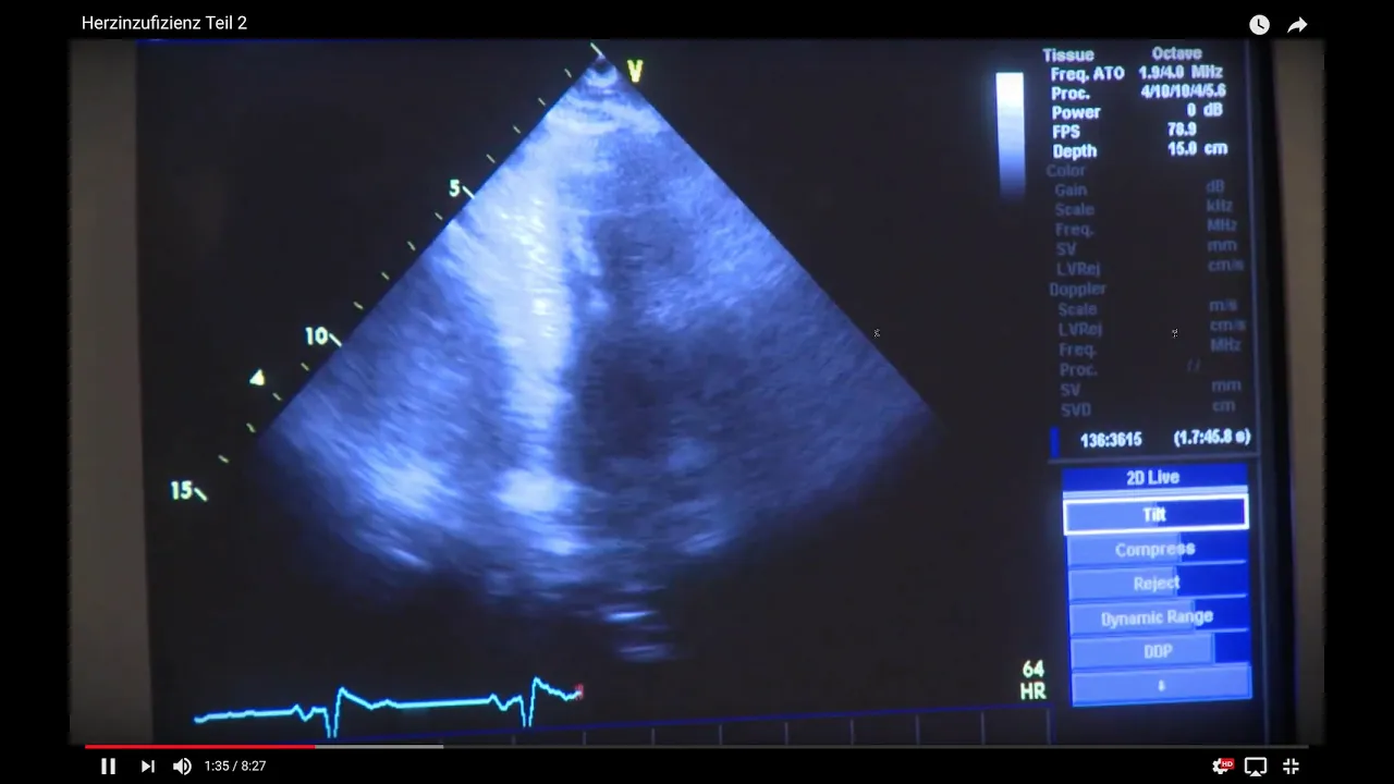 2 Herzinsuffizienz - Symptome