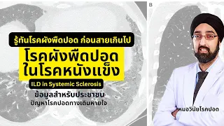 อาการใดบ่งชี้ว่าอาจมีพังผืดปอดในผู้ป่วยโรคหนังแข็ง