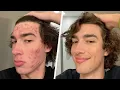my struggles with acne