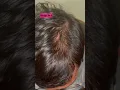 Download Lagu CARA NUMBUHIN RAMBUT PITAK DALAM 2 MINGGU