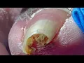 Lagu Pull Out The Nails On Both Sides, Extremely Curly Ingrown Nails【Pedicure Master Lin Jun】