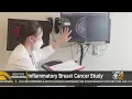 Telltale signs of inflammatory breast cancer