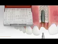 BioHorizons FSK5000 Step-by-Step Drill Sequence for Pro Freehand Surgical Kit