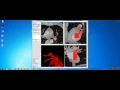 itk snap automatic segmentation with presegmentation mode classification in 6 minutes