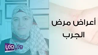 أعراض مرض الجرب وعلاجه دندنها