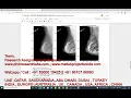 MAMMOGRAM CANCER USING CLAHE PYTHON CODE BREAST CANCER MAMMOGRAM CLAHE PYTHON PROJECT