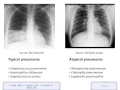 USMLE Step 1 High Yield Infectious Diseases Pneumonia