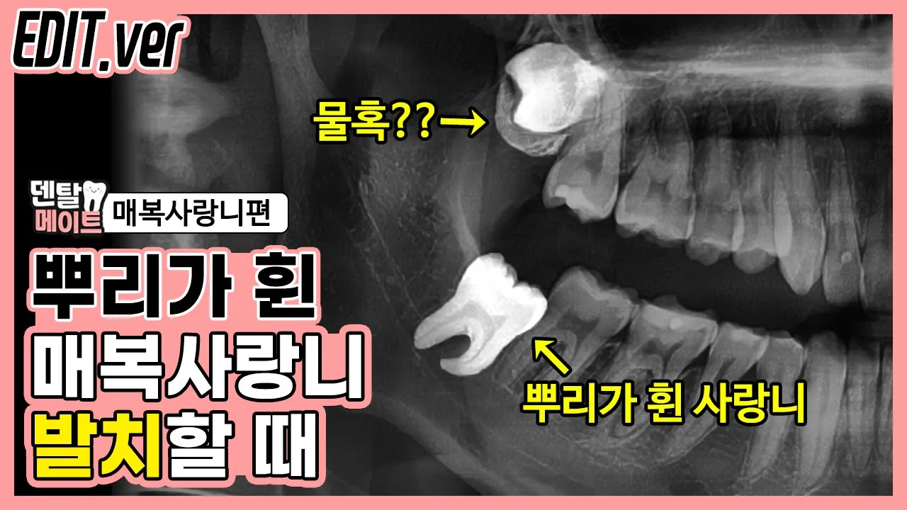 매복사랑니 발치할 때 뿌리가 부러지는 경우(뿌리가 휘어있는 사랑니 & 물혹 발생 가능성이 있는 사랑니)| 덴탈메이트-매복사랑니 편집버전