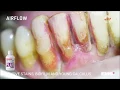 Lagu GBT Step 04: Stains, biofilm and young calculus removal with AIRFLOW® and PLUS powder