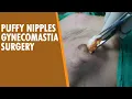 Puffy Nipple Gynecomastia Surgery under Local anesthesia #dezireclinic