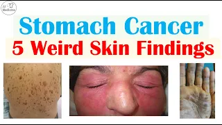 5 Weird Signs of Stomach Cancer (Found on the Skin) | Paraneoplastic Syndromes