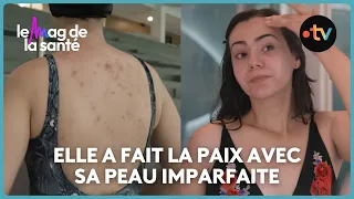 Acné : quels produits sont recommandés ?