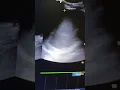 Splenic Abscess