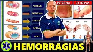 HEMORRAGIAS, QUAIS SÃO OS DIFERENTES TIPOS?