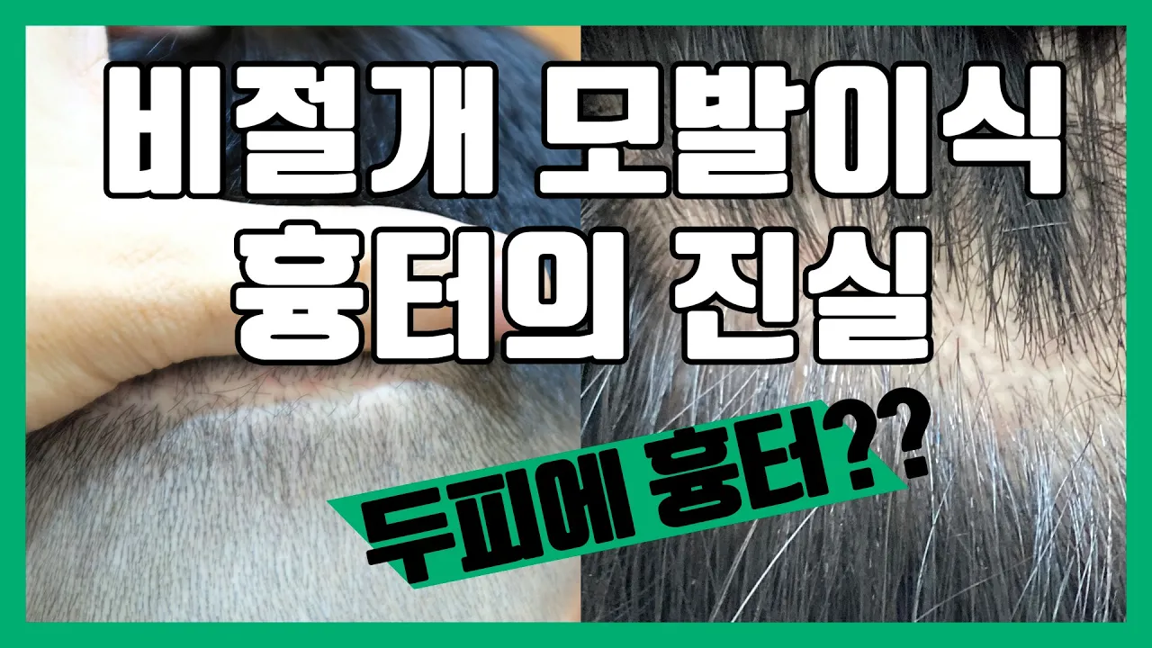 비절개 모발이식은 흉터 없다는데..?