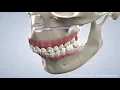 Jaw Surgery at Warren Orthodontics Springville UT
