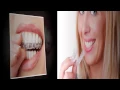 Invisalign Smithtown NY - Michael Kampourakis DDS