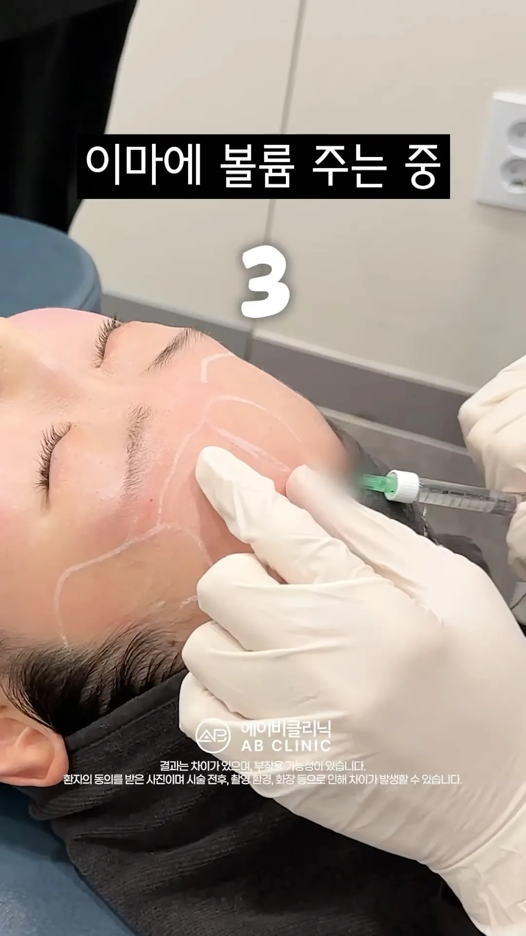 이마 볼륨으로 윤곽 또렷해지기💯