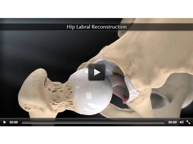 Hip Labral Reconstruction