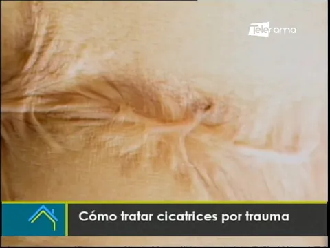 Cómo tratar cicatrices por trauma