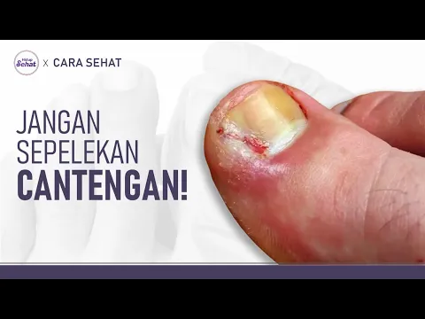 Jangan Tunggu Parah! Ini Gejala dan Cara Mengatasi Cantengan