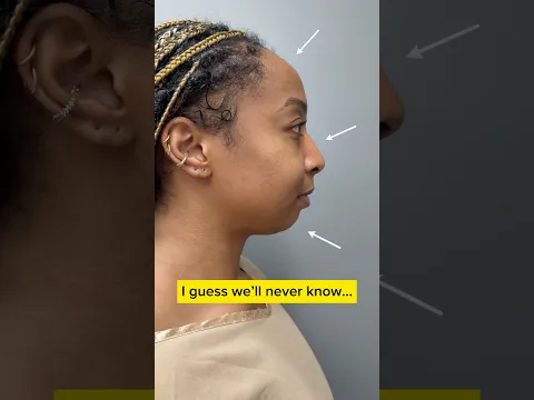 Everyone Thought I Would Look FAKE After Having Plastic Surgery…. 😰 Dr. Truesdale Results