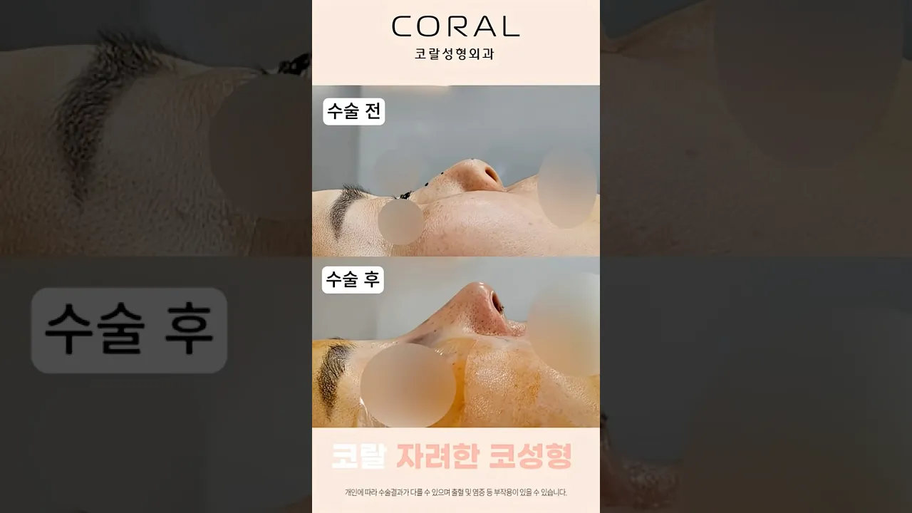 요즘 성형외과 1위 요청: '자려한 코'가 대체 뭐임? #shorts #코성형 #성형외과