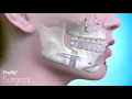 Sleep Apnoea | BiMax Advancement