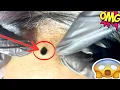 blackheads extractions blackheads extractions