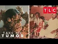 The History of Charmaine s Tumors Take My Tumor TLC