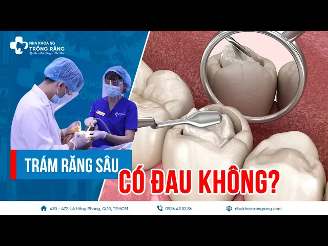 Outline Video Trám răng sâu có đau không?