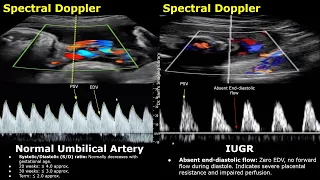 Umbilical Artery Doppler Ultrasound Normal Vs IUGR Fetal Distress Growth Restriction Hypoxia