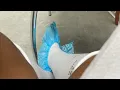 Lipo Journey Surgery Op Days1-9 Beyond Beauty Plastic Surgery Dr Michael Stefan