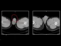 Pelvic Trauma Interesting Radiology Cases