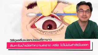 วิธีดูแลเบื้องต้นเมื่อมีเศษผงเข้าที่กระจกตา หรือตาดำ คืออะไร และทำไมจึงไม่ควรพยายามขูดออกเอง