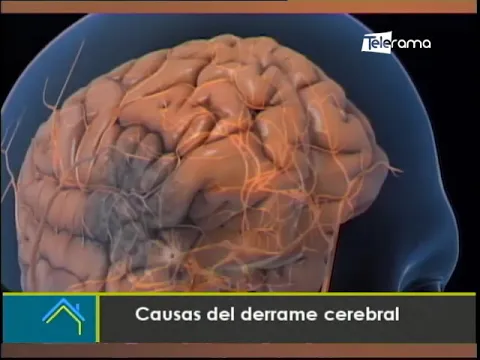 Causas del derrame cerebral