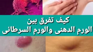 كيف تفرق بين الورم الدهنى والورم السرطانى 