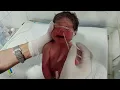 Download Lagu RDS Baby Secretion Management | NG Tube Procedure in NICU#newboranbaby 