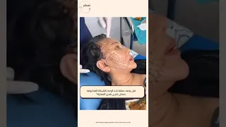 قبل وبعد عملية شد الوجه بالشبكة العنكبوتية تقنية حديثة لشد الوجه بدون اثار جانبية اكسبلور السعودية 
