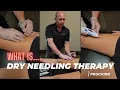 Dry Needling Therapy Bozeman Montana Pro Chiropractic Dr Jon Wilhelm