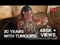 Neurofibromatosis Survivor Faces Her Biggest Surgery Take My Tumor TLC