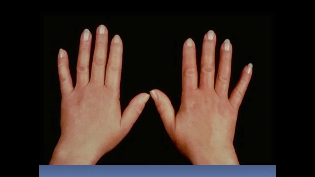 New and Emerging Treatments in Fibrosing Skin Disorders