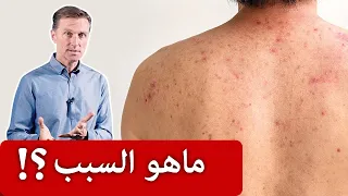 حساسية الجلد بسبب الماء ماهو السبب والعلاج 