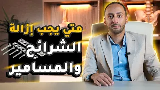 متى يجب ازالة الشرائح والمسامير دندنها