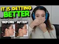Tyler1 Macaiyla Shows Her Chin 3 Months After the Surgery