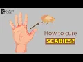 How to cure Scabies - Dr Rajdeep Mysore
