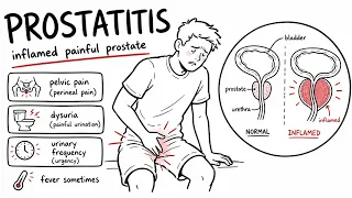 Prostatitis Explained Clearly | Acute, Chronic and Pelvic Pain Syndrome
