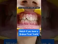 Download Lagu Broken Front Tooth? Fix it NOW! Dr. Srishti Bhatia #teeth #dentist